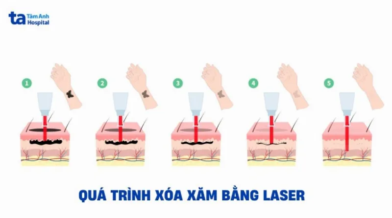 liệu trình xoá xăm bằng laser