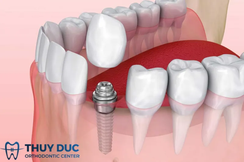 Trồng răng implant 1