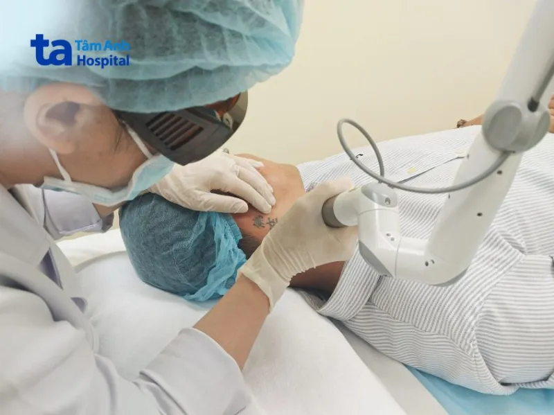 Xóa xăm bằng laser tại bệnh viện Tâm Anh